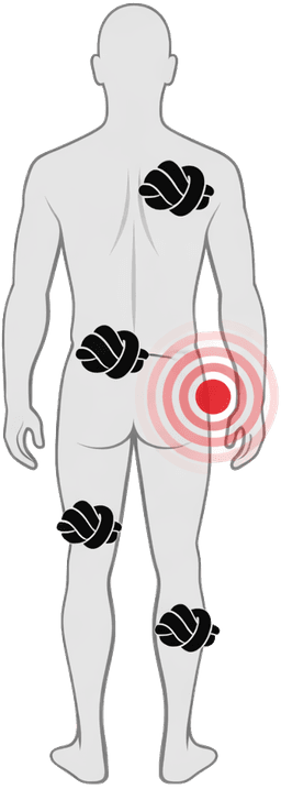 Multiple muscle knots across the body